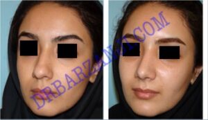 جراحی بینی ، ٣ ماه بعد از عمل