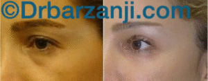 جراحی پلاستیک پلک بالا و تزریق چربی پلک پایین