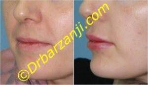 تزریق ژل لب ها