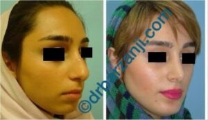 جراحی بینی و پروتز چانه چهار سال بعد از عمل