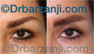 جراحی پلاستیک پلک بالا