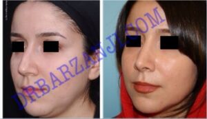 جراحی بینی،۶ ماه بعد از عمل