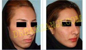 پروتز چانه، ٥ ماه بعد از عمل