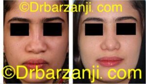 جراحی پلاستیک با پیوند غضروف دنده به بینی