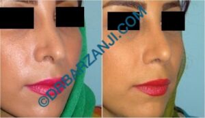 جراحی ثانویه بینی، ترمیم فرورفتگی و بالاکشیدگی پره بینی