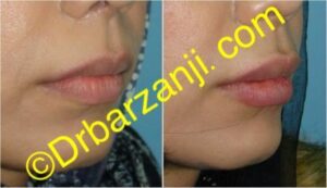 تزریق ژل ژوویدرم به لب