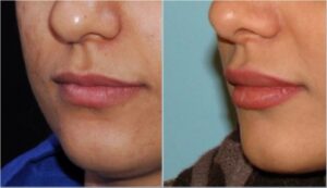 تزریق جوویدرم در لب ، یک سال و نیم بعد