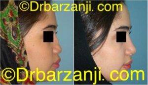 جراحی پلاستیک با پیوند غضروف دنده به بینی