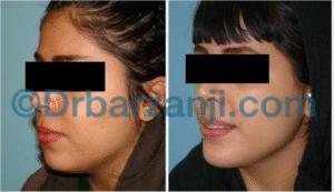 پروتز چانه و لیپوساکشن غبغب یک سال و نیم بعد