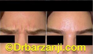 بهبودی خط اخم با تزریق بوتاکس ( دیسپورت )