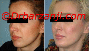 پروتز چانه و گونه هفت ماه بعد از عمل