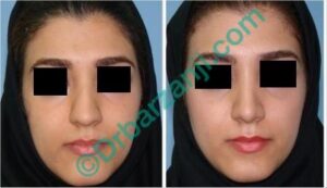 جراحی بینی ٦ ماه بعد از عمل