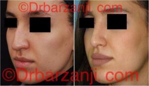 عکس عمل جراحی پلاستیک بینی ۶ ماه بعد