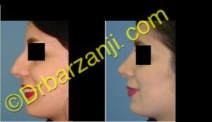 جراحی بینی سه ماه بعد از عمل