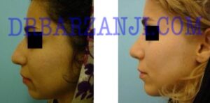 پروتز چانه و جراحی بینی، یک سال بعد از عمل