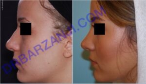 جراحی بینی، یک سال بعد از عمل