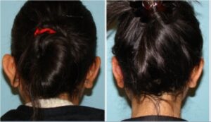 جراحی پلاستیک برجستگی لاله گوش چپ