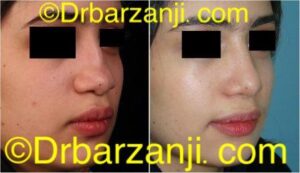 جراحی پلاستیک با پیوند غضروف دنده به بینی