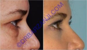 جراحی پلک بالا و پایین، دو ماه بعد از عمل