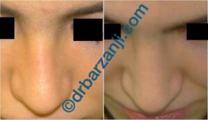 تزریق ژل رادیس در محل فرورفتگی بینی بعد از عمل