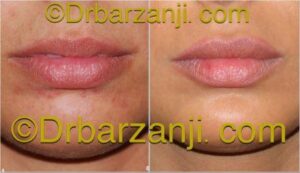 تزریق ژل جوویدرم (ژوویدرم )در لب ، 9 ماه بعد