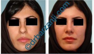 جراحی بینی یک ماه بعد از عمل