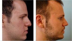 جراحی بینی، یک سال بعد