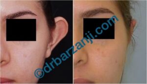 جراحی برجستگی لاله گوش