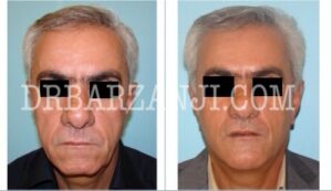 فیس لیفت و پروتز چانه