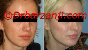 پروتز چانه و گونه هفت ماه بعد از عمل