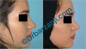 جراحی پلاستیک بینی نه ماه بعد از عمل
