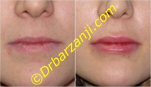 تزریق ژل لب ها