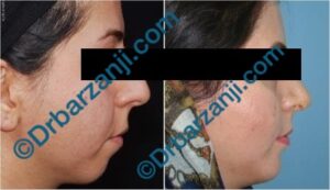 پروتز چانه سه هفته بعد از عمل