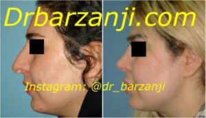 جراحی بینی و پروتز چانه