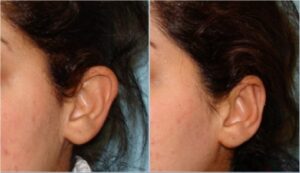 رفع برجستگی لاله گوش