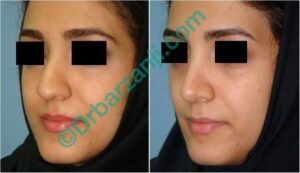 جراحی بینی ٦ ماه بعد از عمل