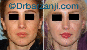 پروتز چانه و گونه دو ماه بعد از عمل