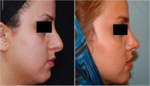 جراحی پلاستیک بینی٣ سال بعد از عمل