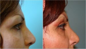 جراحی زیبایی پلک بالا،۳ سال بعد از عمل