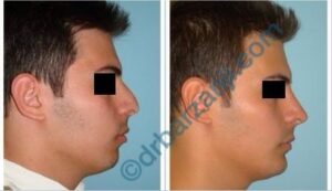 جراحی بینی و پروتز چانه 6 ماه بعد از عمل