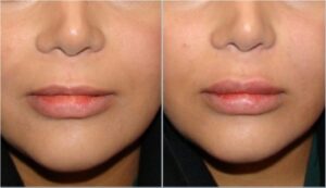 ژل جوویدرم، لب بالا