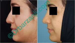 جراحی بینی ٦ ماه بعد از عمل