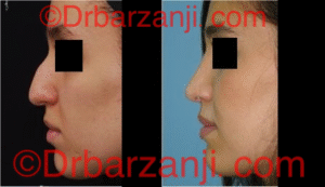 عکس عمل جراحی پلاستیک بینی ۶ ماه بعد