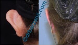 جراحی برجستگی لاله گوش