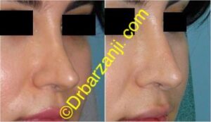 تزریق ژل رستیلن در بینی عمل شده