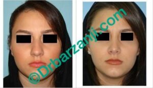 عمل جراحی پلاستیک بینی یک سال بعد