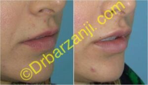 تزریق ژل جوویدرم ( ژوویدرم ) به لب یک هفته بعد