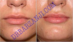 تزریق ژل ژوویدرم به لب ، ٤ ماه بعد