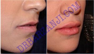 ژل جوویدرم در لب بالا و پایین، ٥ هفته بعد