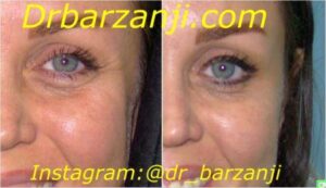 بهبود چین و چروک اطراف چشم با تزریق بوتاکس ( دیسپورت )